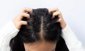 5 myths of dandruff busted