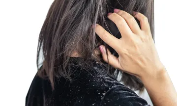 Does dandruff really need medical treatment? Why?