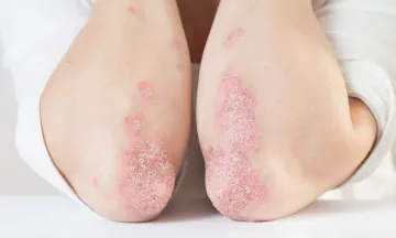 Don’t Fall for These Psoriasis Myths!