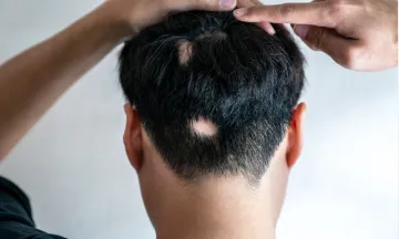  Efficacy of Homoeopathy in Patchy Hair Loss