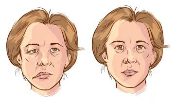 HOMEOPATHY & BELL’S PALSY