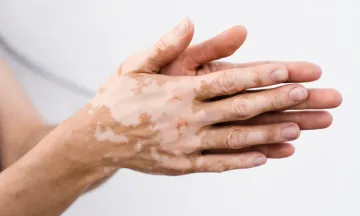 Homeopathy…A boon for Vitiligo