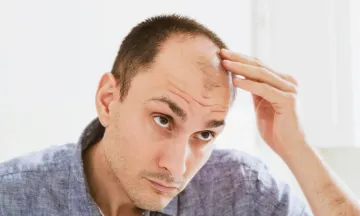 HOMEOPATHY TREATS THE CAUSE & EFFECT OF HAIR LOSS