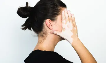 How to identify vitiligo