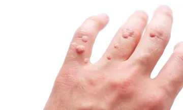 How to Get Rid of Warts the Holistic Way?