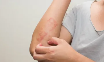 Is a rash a sign of food allergies or eczema?