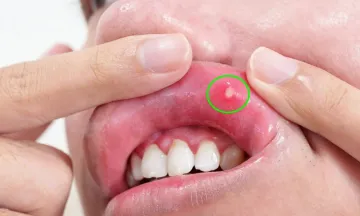 Is it just a Simple Mouth Ulcer?