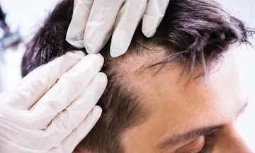 Mesotherapy for Hair Loss and Hair Growth