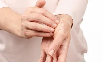 PSORIASIS?? PREVENT ITS LEAD TO PSORIATIC ARTHRITIS