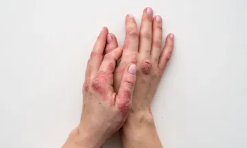 Starting a Relationship? Don't Let Psoriasis Disease Get in the Way