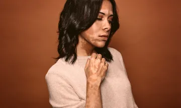 How does emotional stress affect Vitiligo?