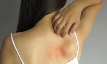 Treat Summer Skin Problems with Homeopathy