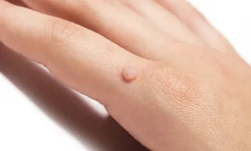 Warts Treatment in Homeopathy