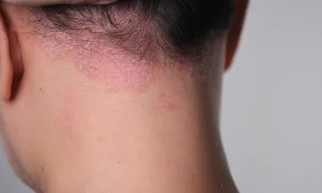 What causes Psoriasis of the scalp?