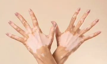 The 'White Lies': Debunking Vitiligo Myths & Facts