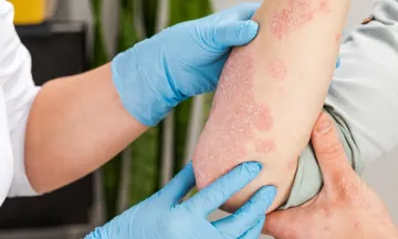 Why do people get Psoriasis?