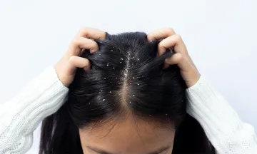 Anti-dandruff shampoos – do they really work?