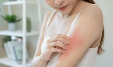 Eczema triggers you must avoid