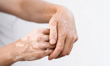 Is Vitiligo permanent...How to treat Vitiligo?