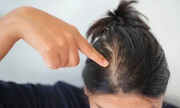 Is your hair loss just due to stress or there is some underlying disease causing it?
