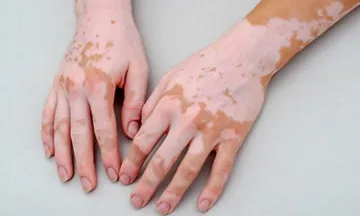 5 things to know about vitiligo disease