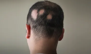 Types of Alopecia