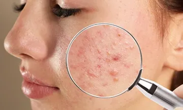 Acne vs. Pimples