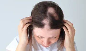 Can alopecia areata affect women?