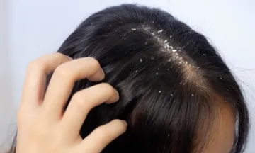 Can dandruff cause hair fall?