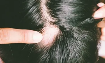 Is castor oil good for alopecia areata?