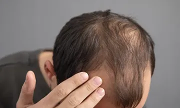 Causes and Treatment of Scarring Hair Loss