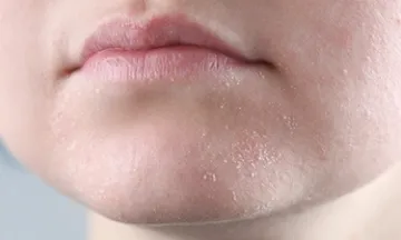 Dehydrated Skin: Causes, Symptoms, and Best Treatments