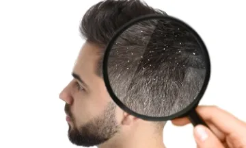 Don’t let dandruff ruin your relationship