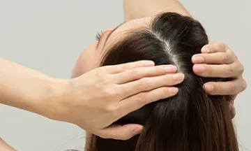 Female Pattern Baldness in 20s – Causes, Symptoms & Best Treatments