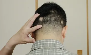 Causes of Alopecia Areata: Understanding the Triggers & Risk Factors