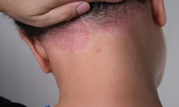 Symptoms of Scalp Psoriasis