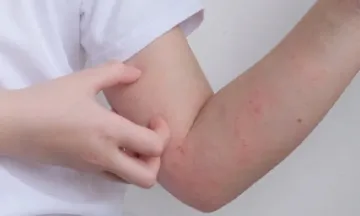 Close-up of itchy, red rash on a child's arm.