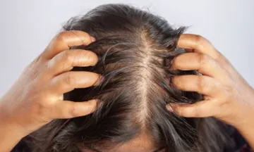Can hair fall in women occur in the 30s?