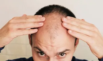Understanding Male Pattern Baldness: Find Answers & Hope for Hair Health
