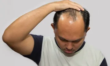 Male Pattern Baldness symptoms