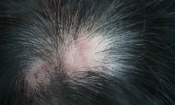 Lichen planus and hair loss
