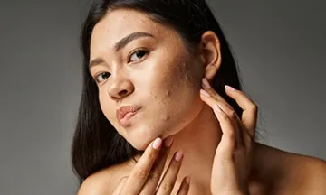Hormonal acne: what causes it and how to treat it?