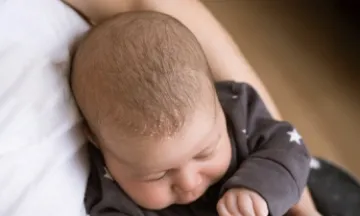 How does Seborrhoeic Dermatitis affect babies?