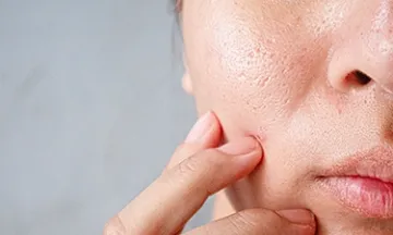 How to Reduce Acne Scars Naturally and Effectively