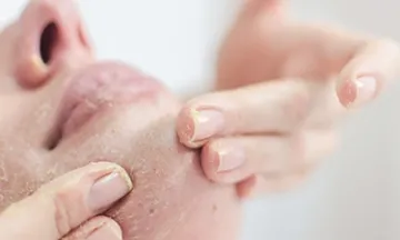 How to remove dead skin from face