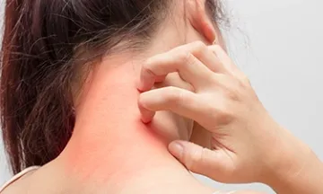 How to Remove Fungal Infection Marks from Skin