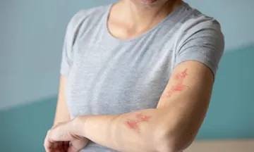 How to treat and get rid of hives