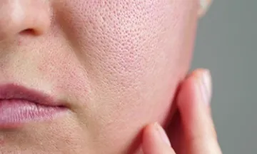Large Pores vs. Acne Scars: Key Differences and Treatments