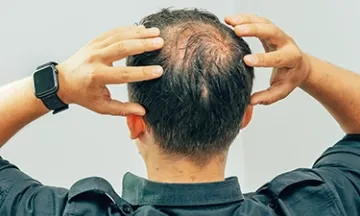 Know these stages of male pattern baldness