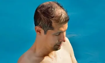 Why men experience hair loss in summer?